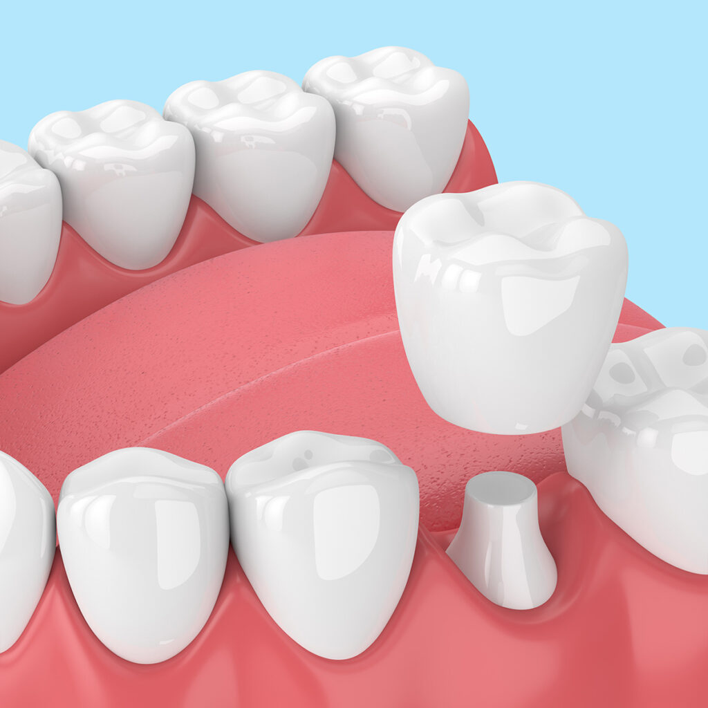 Dental Crowns by Seaside Dentistry in Mobile, AL