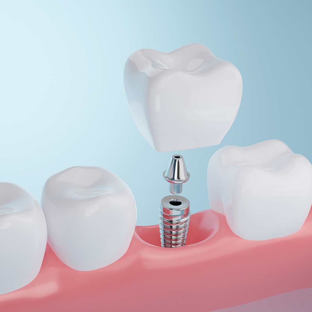 Dental Implants - Seaside Dentistry Mobile, AL